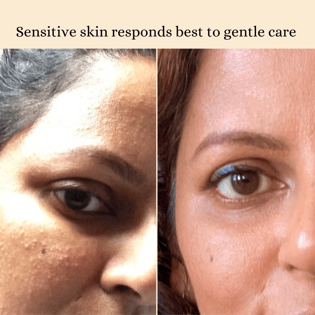 Sensitive skin responds best to gentle care